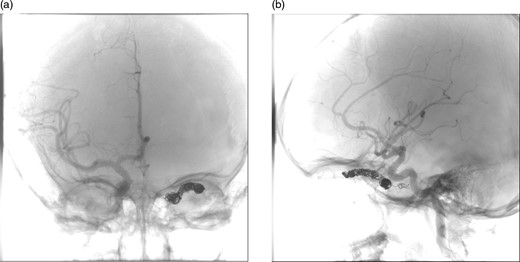 (a) and (b) Post-procedural digital subtraction angiogram under general anaesthesia shows no evidence of a residual CCF following coil embolization.