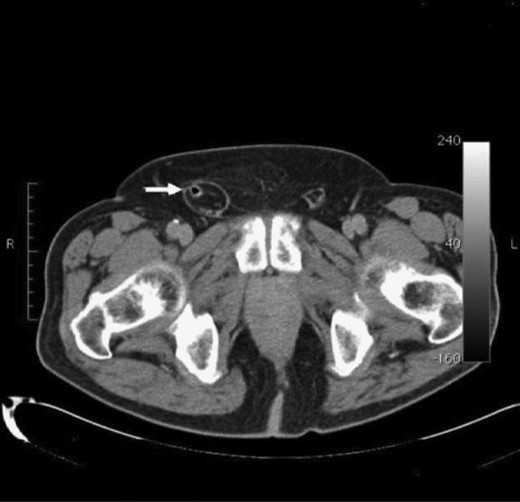 CT scan of a right inguinal hernia with incarcerated, inflamed vermiform appendix and an obstructing fecalith.