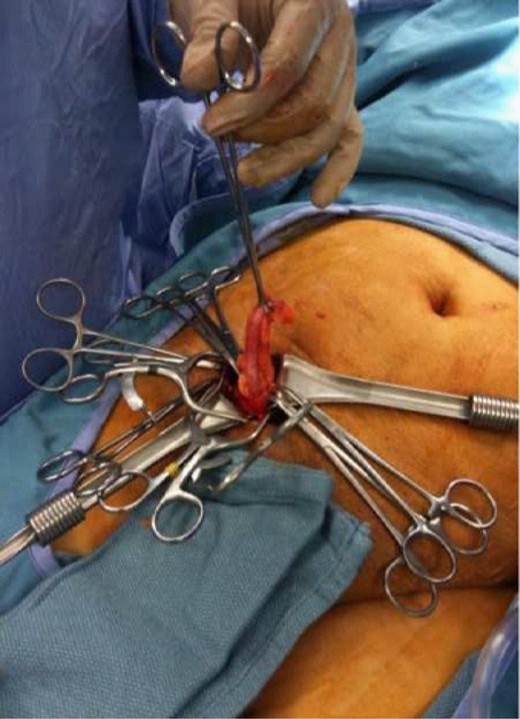 Inflamed vermiform appendix incarcerated in a right inguinal hernia.