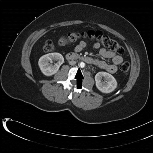 Initial CT scan shows enhancing vascular abnormality on the right side of the aorta, shown by the black arrow.