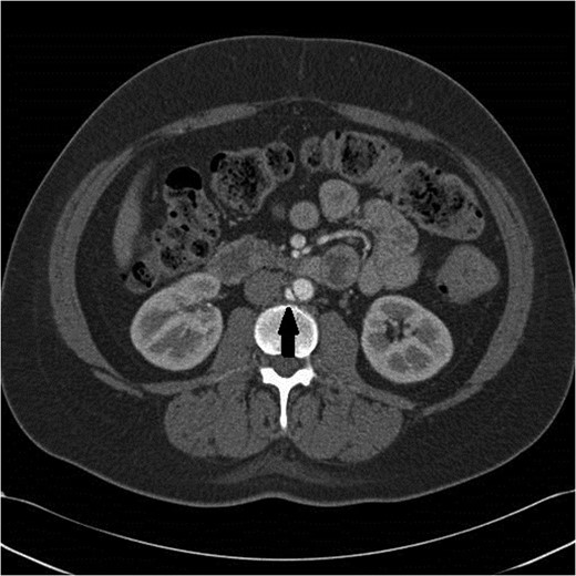 Pseudoaneurysm now clearly seen 3 months later.