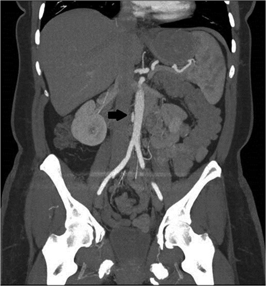 Black arrow pointing to pseudoaneurysm with enhancing flow outside of the aortic lumen.