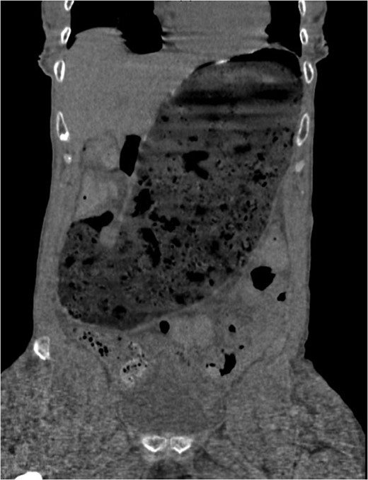 Computed tomography scan at presentation (prior to perforation) demonstrating gastric distention secondary to amyloid provoked gastroparesis with fecalization of gastric contents.