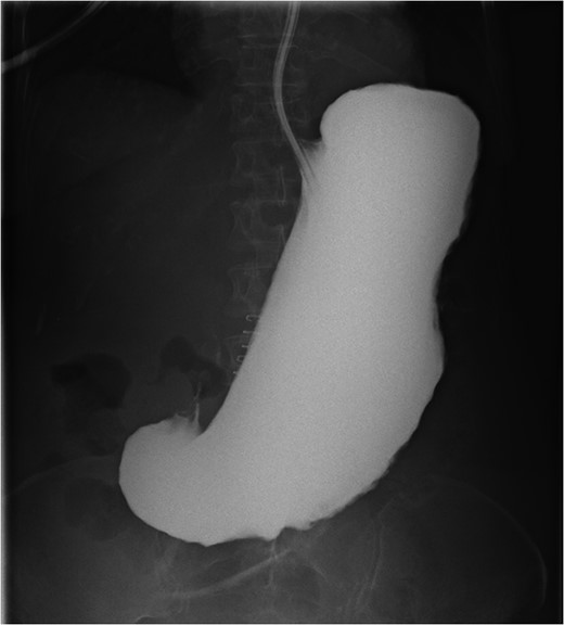 Upper gastrointestinal series 2 h after gastrograffin contrast administration down nasogastric tube demonstrates no leak and no passage of contrast from severe gastroparesis.
