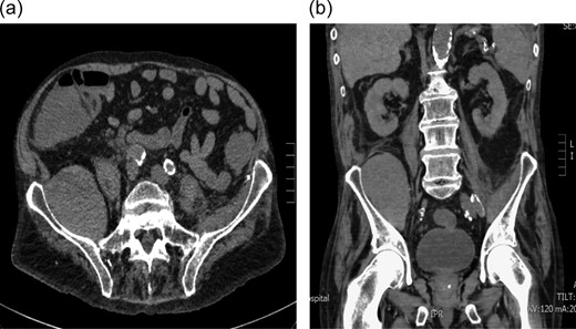 (a and b) Axial and coronal computerized tomography scans demonstrating a large iliacus hematoma in the right iliac fossa.