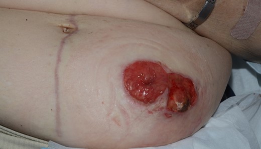 Peristomal pyoderma gangrenosum with presence of necrotizing ulcer near stoma site prior to surgery.