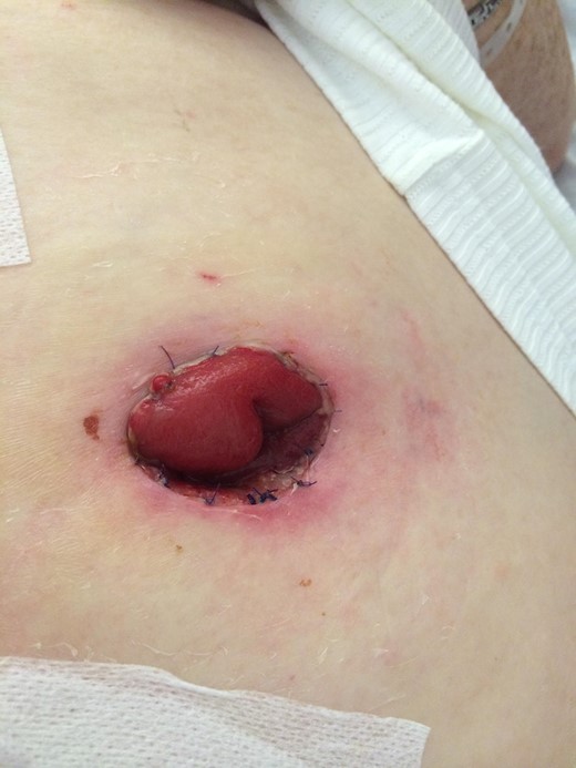 Healed site of peristomal pyoderma gangrenosum with no evidence of recurrence 12 months post op.
