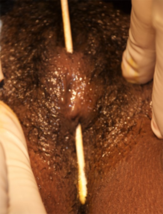 Clinical evaluation at presentation demonstrating fusion of the labial bodies. A simple swab demonstrates communication behind the labial fusion.