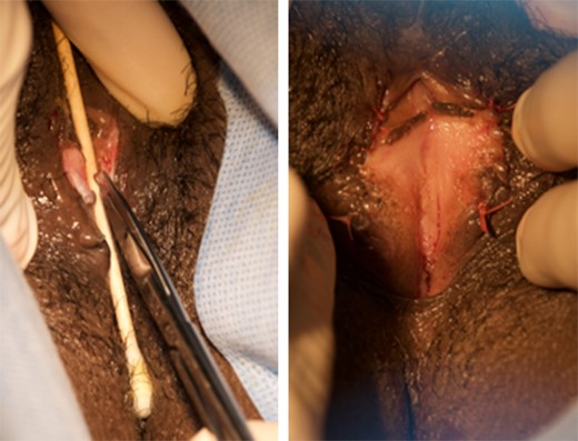 Defibulation procedure: incision along the tract of labial fusion (left) and open vaginal introitus following defibulation (right).