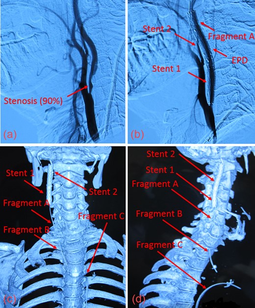(a) Digital Subtraction Angiography of patient prior to angioplasty with 90% stenosis of the ICA. (b) Fractured guidewire when patient presented to our facility. The EPD cannot be clearly seen. (c) Reconstructed CT image in anterior view showing the 3 guidewire fragments (Fragments A, B, C) and the 2 carotid stents (Stent 1 and Stent 2) in the right ICA. (d) Reconstructed CT image in the right lateral view of guidewire fragments and stents.
