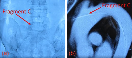 (a) The inferior aspect of Fragment C extended down to the femoral artery. (b) The superior aspect of Fragment C penetrated the thoracic aorta.