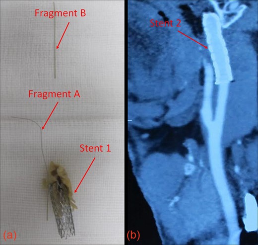 (a) Guidewire fragments and Stent 1 after removal from the patient. (b) CT image showing patent vasculature at 30 months post-operation.