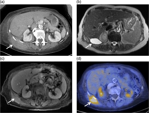(a) Axial image of the CT of the abdomen with IV contrast, demonstrating a complex partially cystic, partially solid enhancing mass abutting the right hepatic lobe and right kidney and extending into the abdominal wall. (b) Axial T2-weighted sequence of the abdomen (axial T2 Single Shot Fast Spin Echo) showing the cystic component of the mass involving the right retroperitoneal space. (c) Axial T1-weighted fat saturation post-contrast sequence of the abdomen (axial T1 Liver Acquisition with Volume Acquisition after the intravenous administration of gadolinium) demonstrating enhancement of the solid component of the mass extending to the right flank musculature. (d) PET/CT showing increased FDG activity at the solid component identified on CT and MRI within the right flank musculature.