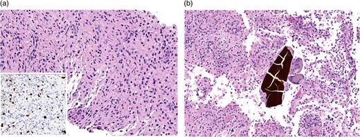 (a) Needle core biopsy (H&E) showing low-grade spindle cell lesion including variably increased labeling rate by Ki-67 immunohistochemistry (inset). (b) Subsequent incisional biopsy of the mass (H&E) shows a histiocytic and multinucleated giant cell response to bile concretions.
