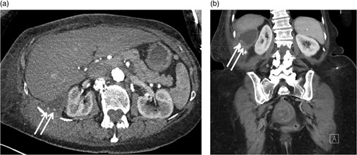 Axial (a) and coronal (b) CT images with IV contrast demonstrating round foci of calcium within the cystic component of the mass involving the right retroperitoneal space.