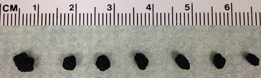 Photomicrograph demonstrating gallstones retrieved from the patient's mass at the time of incisional biopsy and for several weeks following the procedure.