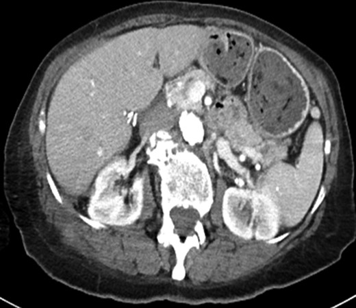 Axial CT image obtained 3 months after the patient's operation showing resolution of the solid and cystic mass.