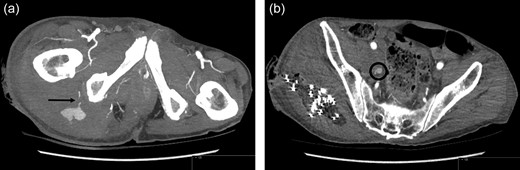 Contrast CT Scan: (a) Inferior gluteal artery haemorrhage. (b) Second site of haemorrhage at the level of division of the internal iliac artery into its anterior and posterior branches, anterior to the sacroiliac joint.