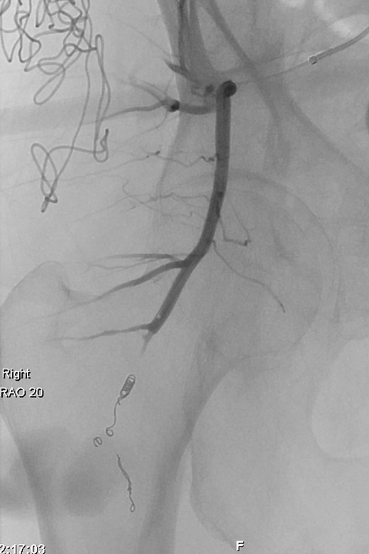 Interventional Angiogram: Deployment of seven coils to embolize the inflow and outflow vessels of the inferior gluteal artery pseudoaneurysm.