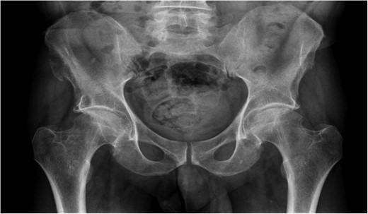Radiograph demonstrating a right-sided iliac exostosis.