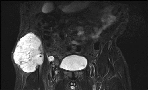 MRI showing a right-sided tumour involving the iliac wing.