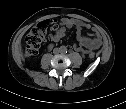 CT abdomen demonstrating thickened segment of ascending colon.