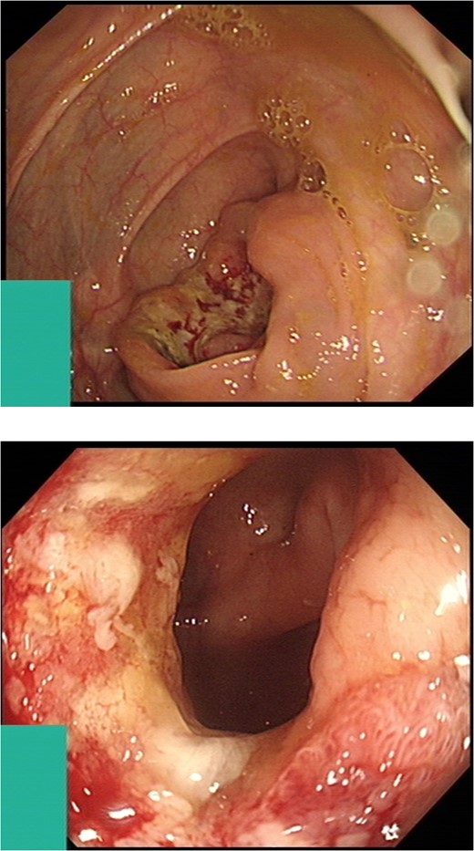 Intraluminal images demonstrating a lesion at the hepatic flexure.