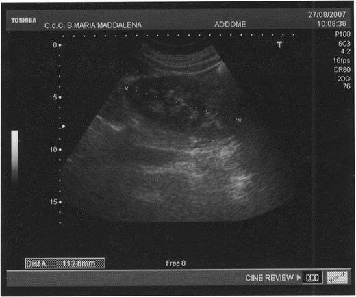 The abdominal ultrasound (US) shows an ovoid swelling, misinterpreted as a partially organized hematoma in the contest of the right gluteus maximus muscle.