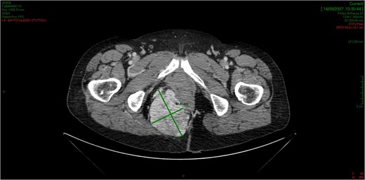The CT scan demonstrates a solid neoformation in the right ischiorectal fossa.