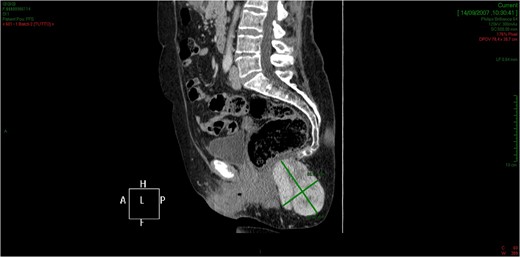 The lesion extends cranially until impressing the wall of the rectal ampulla, with no apparent infiltration.