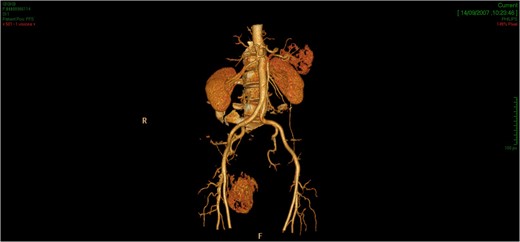 The tridimensional reconstruction shows the rich vascularization of the neoplasm.