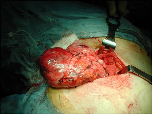 Posterior surgical approach and intra-operatory appearance of the neoplasm.