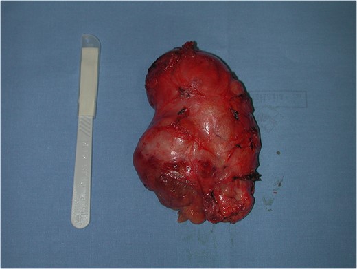 Macroscopic aspect of the neoplasm.