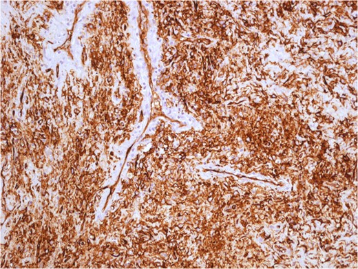 Variable cellularity and vascular patterns hemangiopericitoma-like in solitary fibrous tumour.
