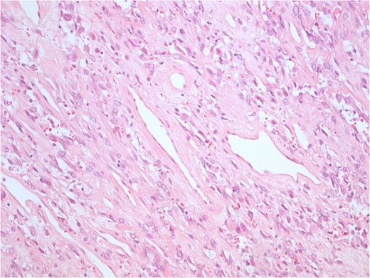 Uniform spindled cells in variably collagenous and vascular pattern. The tumour cells form random and trabecular arrangements.