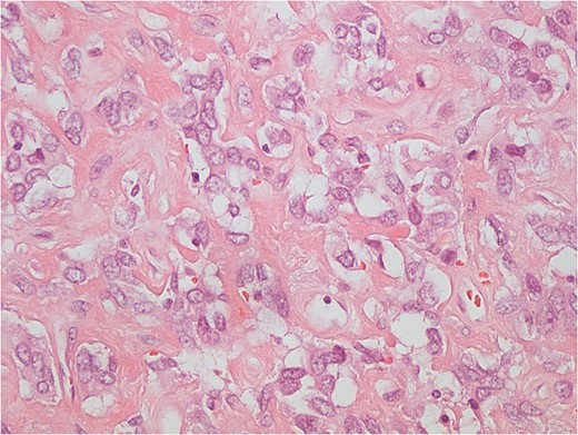 The tumour cells have indistinct cytoplasm and oval nuclei, with inconspicuous nucleoli. Collagenous background is evident. Mitotic activity is absent. SPT cells are positive for BCL2 and CD34.