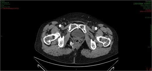 The CT scan demonstrates an hypodermal recurrence of the lesion in the side of resection marked with a metallic clip.