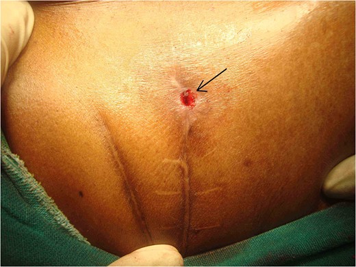 Showing cutaneous opening at anterior end of one of the surgical scar in right lumbar region.