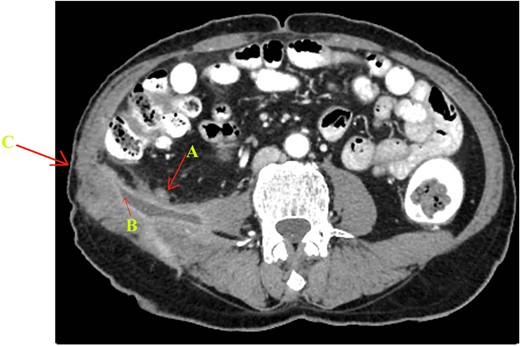 MDCT abdomen with thin axial post-contrast image showing (A) appendix tip opening in (B) psoas abscess cavity leading to (C) fistulous tract opening externaly in right lumbar region.