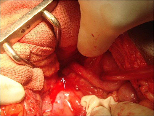 Intraoperative image showing retrocaecal appendix with tip adhered to psoas muscle.