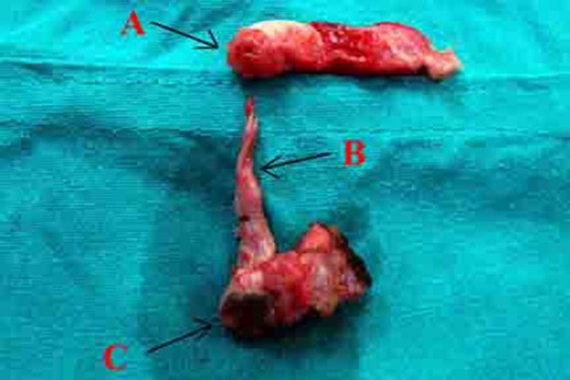 Post-operative specimen showing (A) appendix with perforated tip communicating to (B) fistulous tract with (C) cutaneous opening.