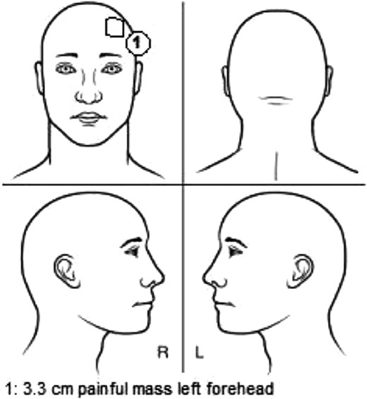 Schematic representation of the lesion location. The soft-tissue component was measured at a diameter of 3.3 cm and located on the left forehead near the hairline.