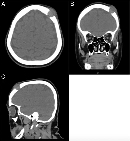 CT soft tissue demonstrating the presence of a lytic lesion in the left frontopartietal region. (A) Axial cut, (B) coronal cut and (C) sagittal cut.