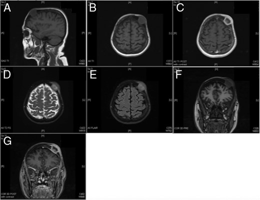 MR imaging redemonstrating the presence of a left frontoparietal mass that does not appear to invade the dura. (A) Sagittal T1, (B) axial T1, (C) axial T1 with contrast, (D) axial T2, (E) axial FLAIR, (F) coronal pre-contrast and (G) coronal post-contrast.