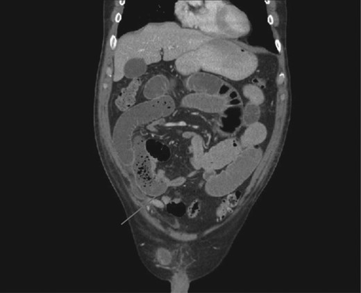 CT scan demonstrating transition point between dilated proximal and collapsed distal small bowel.