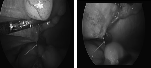 Laparoscopic view of self-anchoring suture adherent to the small bowel causing the obstruction.