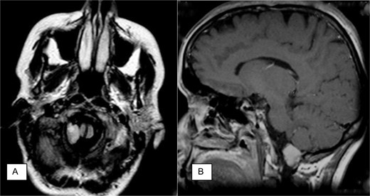 Neuroradiology findings. (A) Axial fast fluid-attenuated inversion recovery (FLAIR) image demonstrates intradural mass at the right foramen magnum resulting in slight displacement of the medulla and transdural hypoglossal canal involvement. (B) Sagittal contrast-enhanced T1-weighted spin-echo image demonstrates intradural mass at foramen magnum.