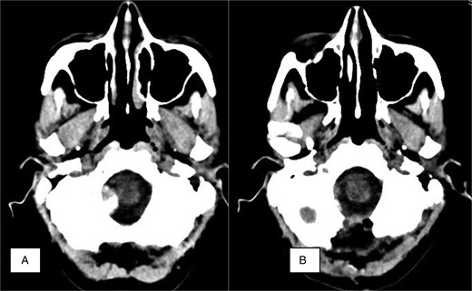 Neuroradiology finding. (A) Axial CT. Preoperative calcified mass at the right foramen magnum resulting in slight displacement of the medulla. (B) Axial postoperative CT showing no residual tumor and bone resection.