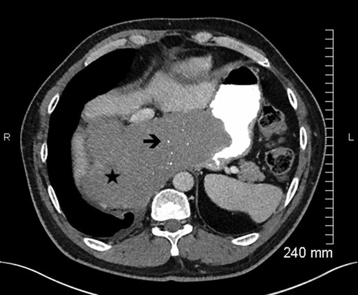 Axial view contrast-enhanced MDCT (portal phase) with oral opacification, in a x year-old men with a large esophageal GIST, showing a lesion (★), well-circumscribed, with small calcifications (è) (rare). The lesion is homogeneous (no kystic or necrotic parts) without hypervascularization.
