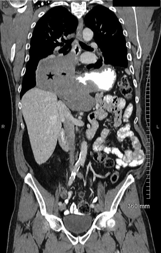 Coronal view of contrast-enhanced MDCT showing the exophytic, non-obstructive lesion (★) located at the esogastric junction.
